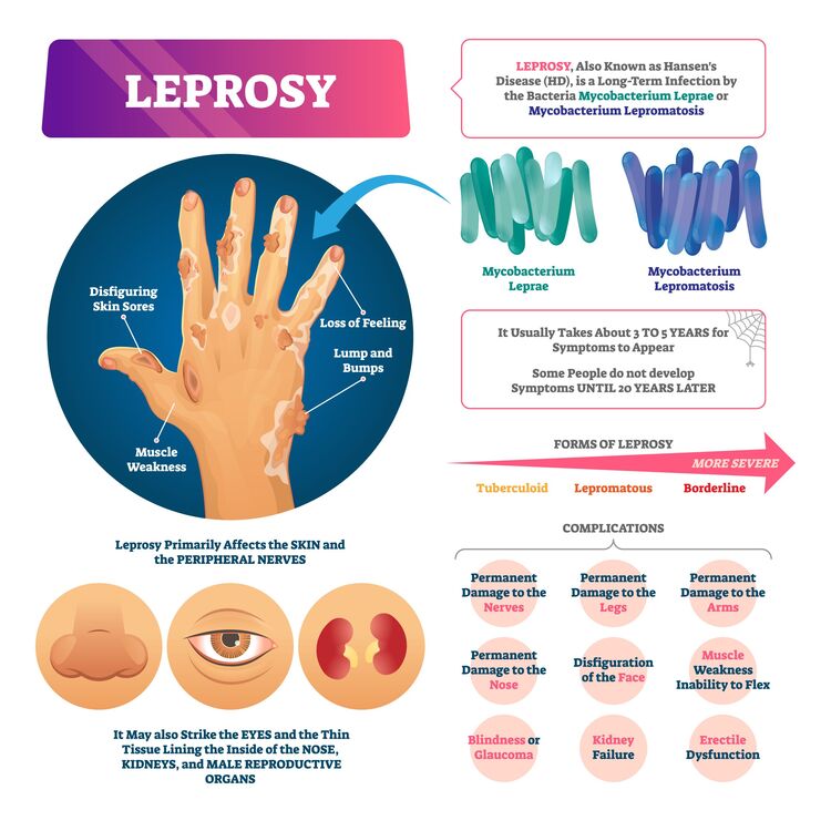 Leprosy types and symptoms of leprosy